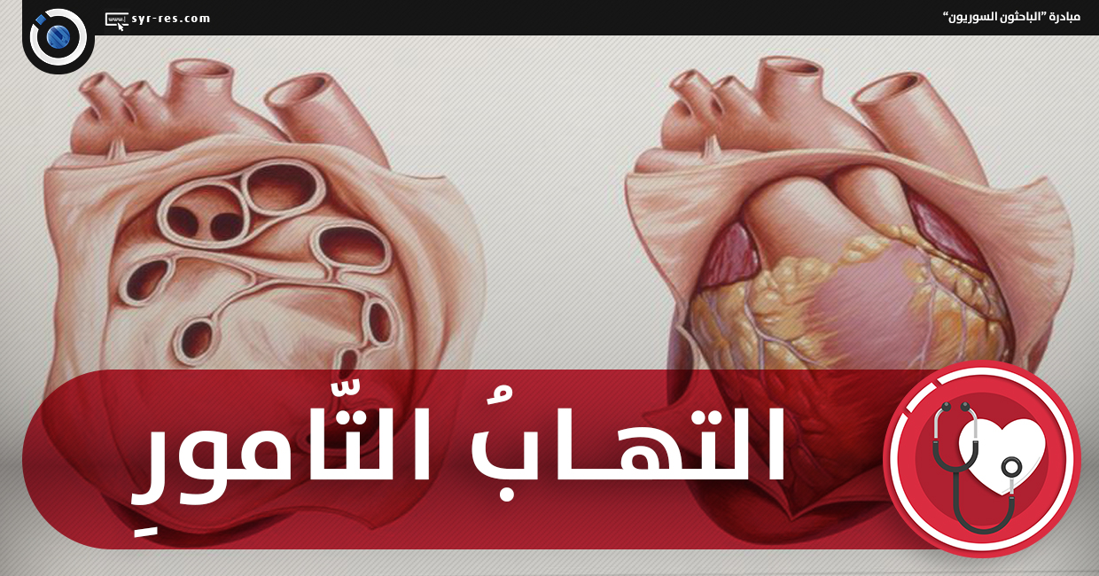 اعراض التهاب التامور ، اعراض عن هذا المرض يمكن ان تكون لديك 21872 1