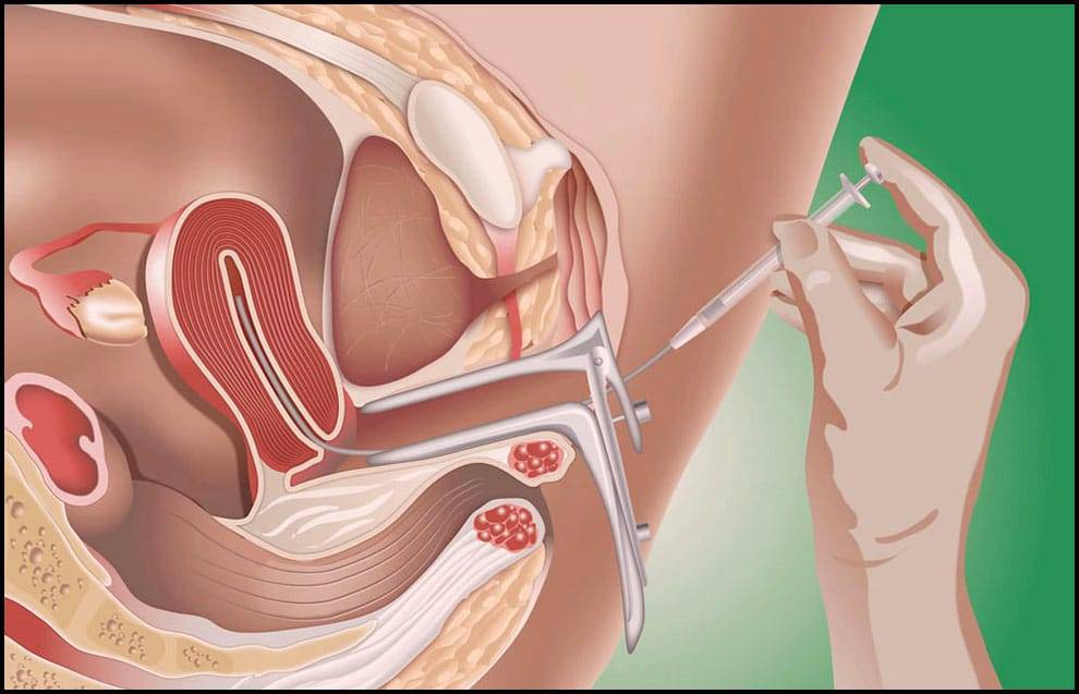 اخواتي انا لي 14 يوم بعد ترجيع الاجنة وعملت تحليل طمنوني