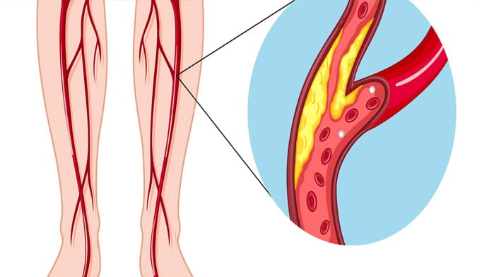 معلومات عن امراض الاوعية الدموية , احترس منه